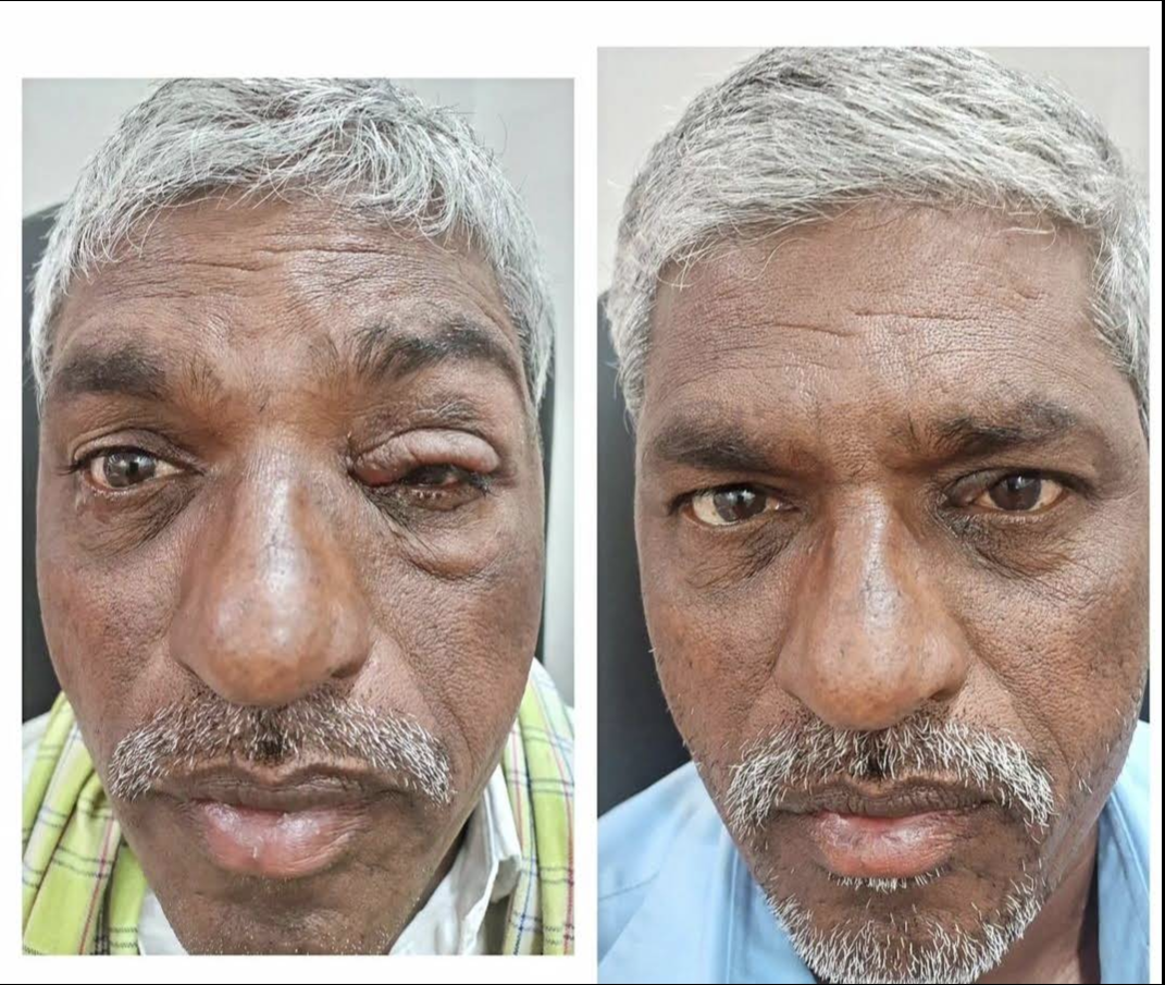 Before and after recovery from an eye condition