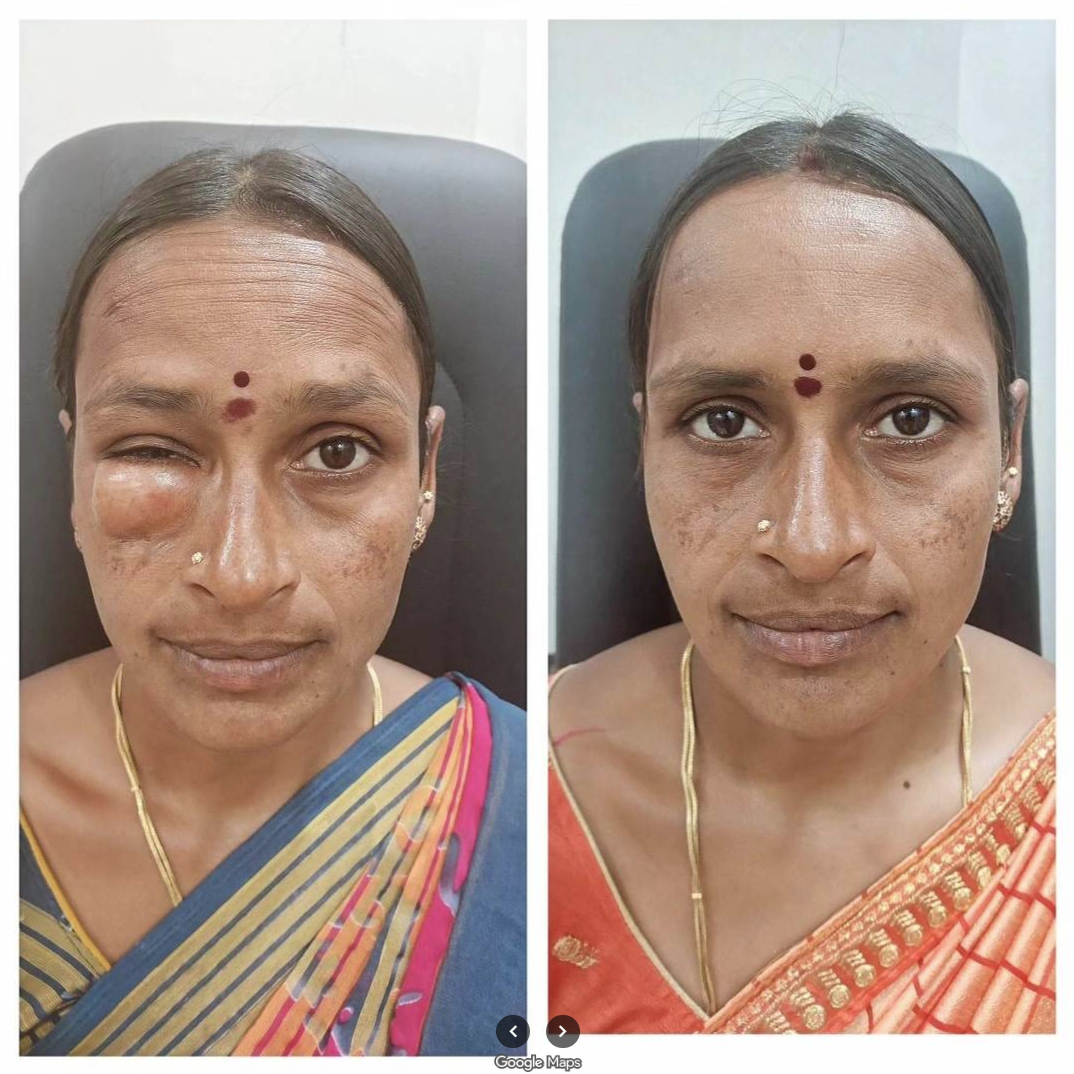 Before and after recovery from facial swelling near the eye